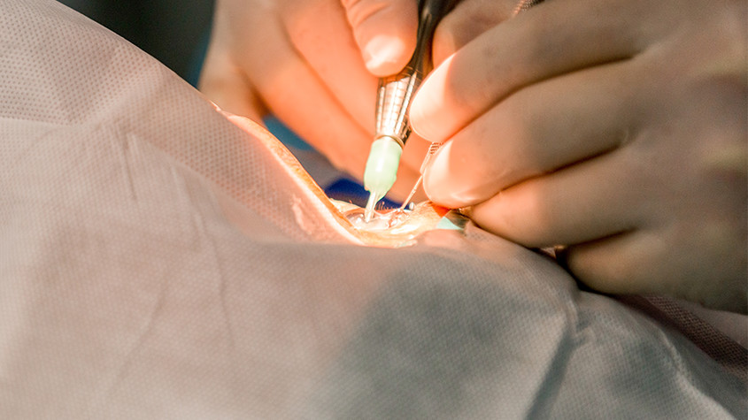 Limbal Relaxing Incisions