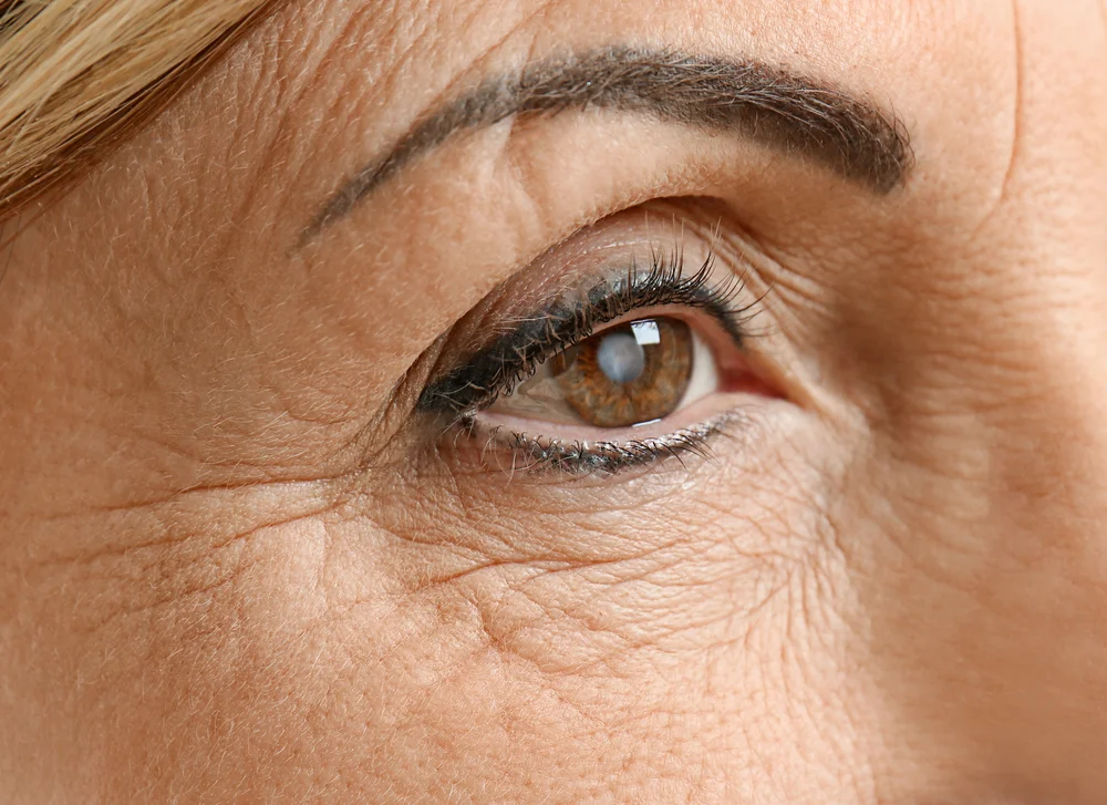 Cataract Surgery Co-Management