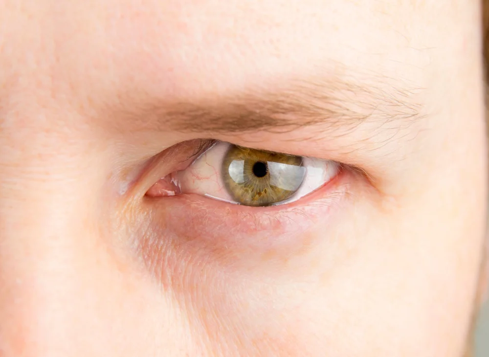 Why Should You Consider Eyelid Rejuvenation