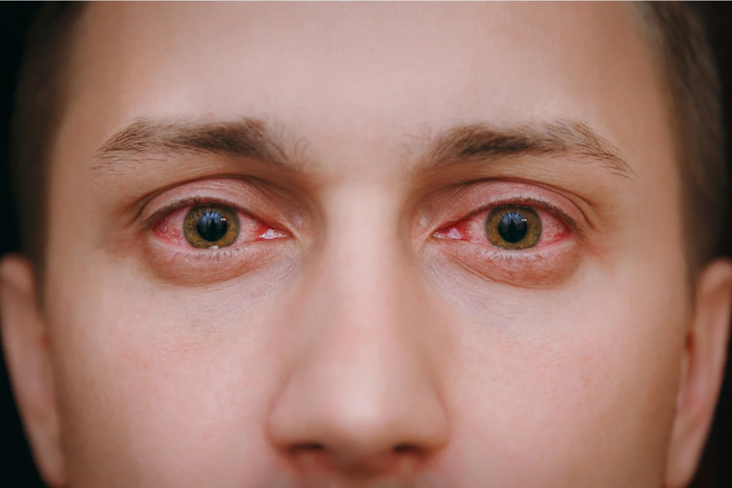 Treating Eye Infections