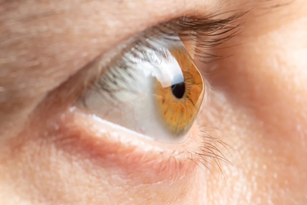 Astigmatism