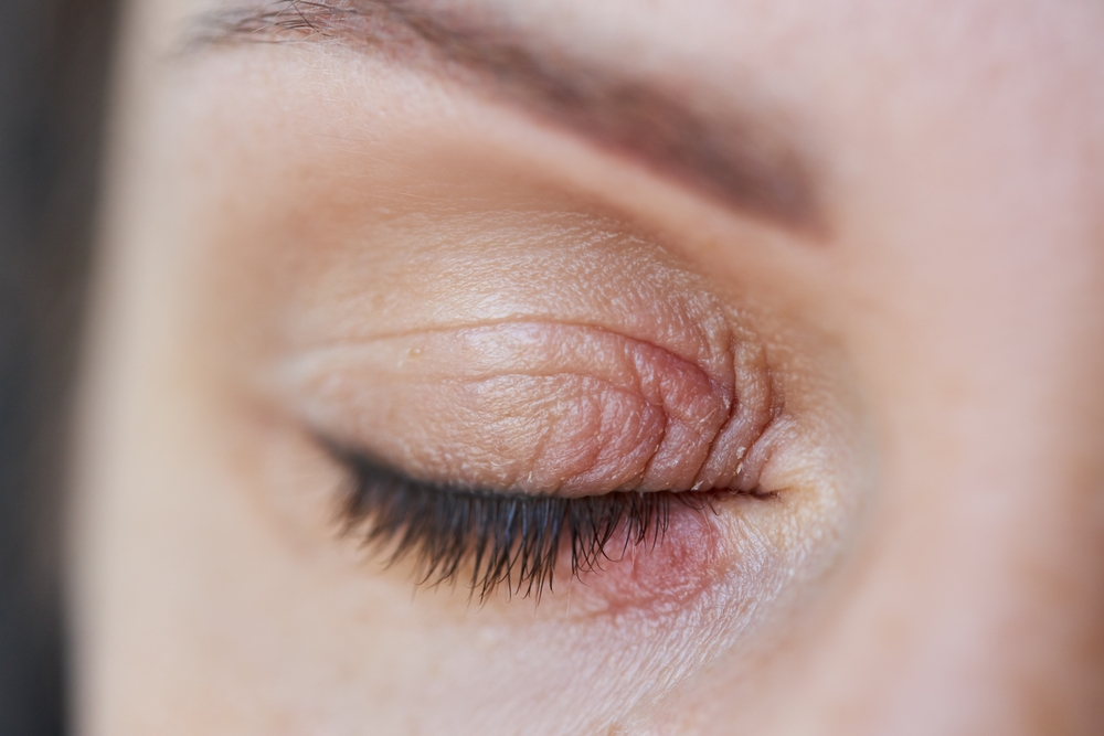 Eyelid Hygiene