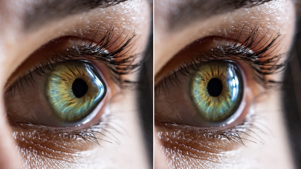 Keratoconus and Your Treatment Options
