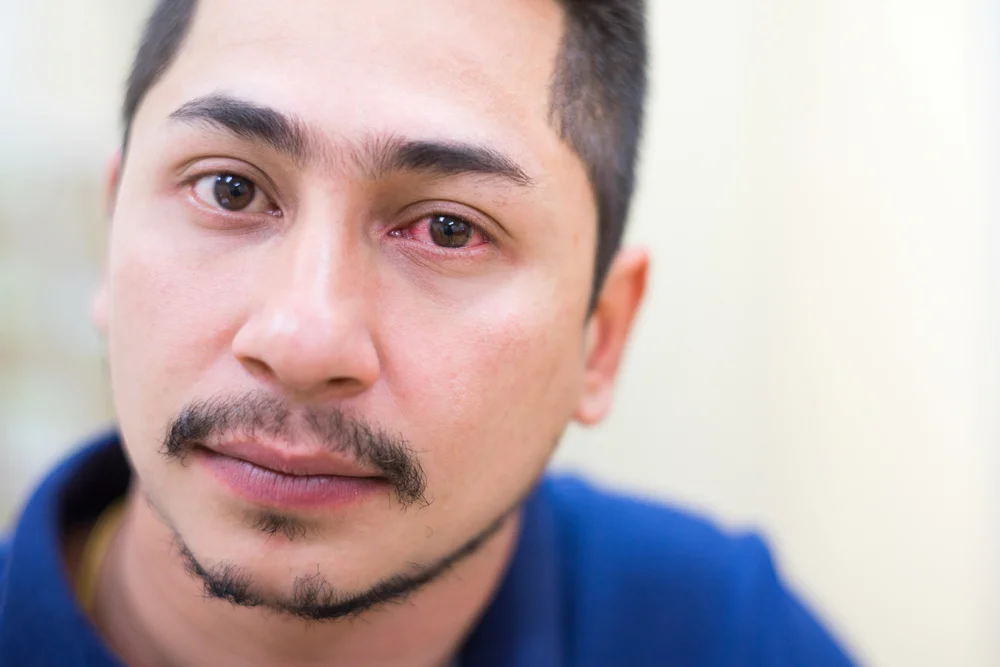 How to Treat Pink Eye